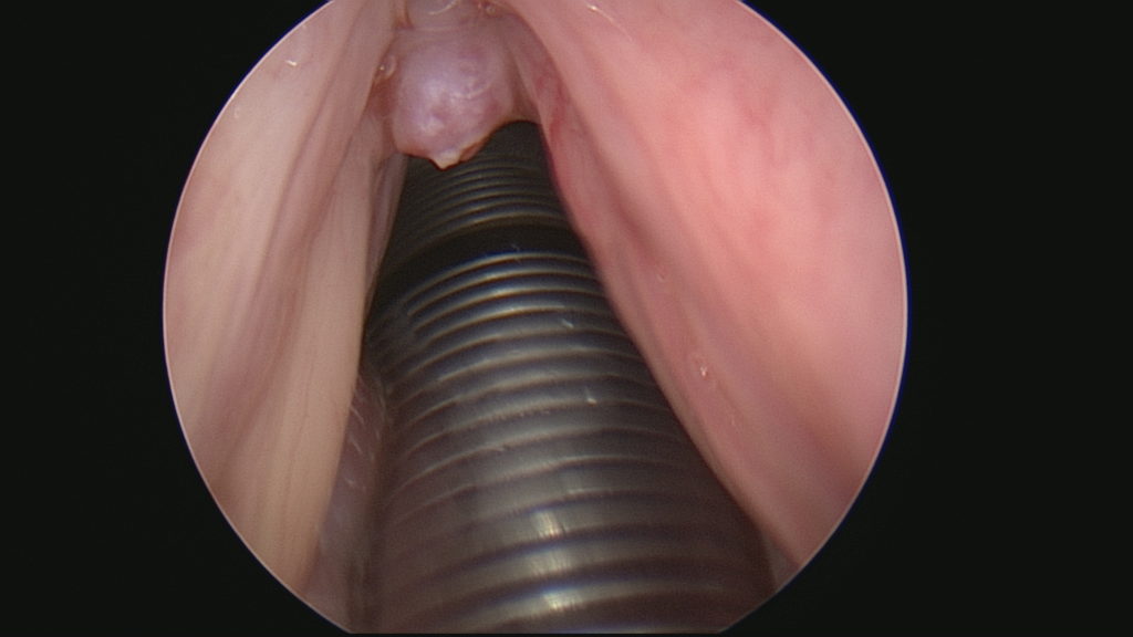 Vocal Chord Polypoid lesion