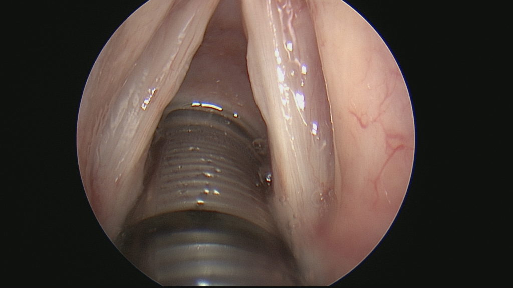 Vocal Cord Polyop